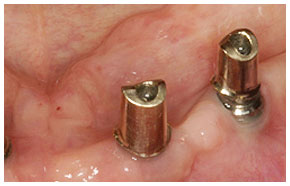 Implantataufbauten fr teleskopgetragenen Zahnersatz